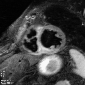 ECG triggered Black-Blood T2w-STIR FSE Technique edema-weighted MRI 93 ECG 2000 Non-selective + Selective 180 pulse pair