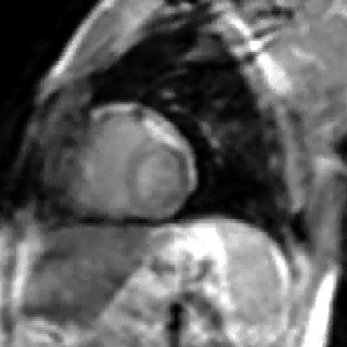 Real-Time MRI Pleural pressure Pleural pressure SV C RA R V L A LV IV C