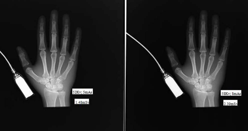 Hand with: - DR - 52Kv;5mAs