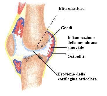 malattia determina: - inizialmente un assottigliamento "per consumo" della cartilagine