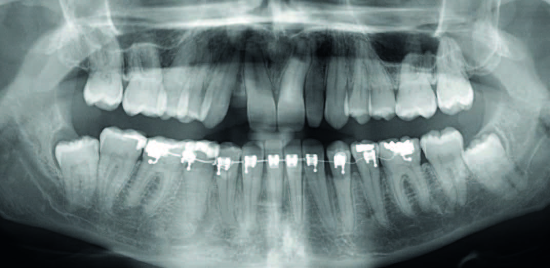 Ritrattamento ortodontico e riabilitazione mediante l utilizzo di impianto narrow platform in un caso di agenesia di un laterale con spazio medio-distale ridotto Autori_P. Borelli*, U. Marchesi**, E.
