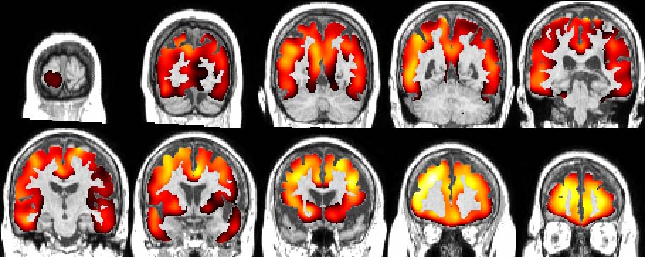 Neurology 2009 in press 11C