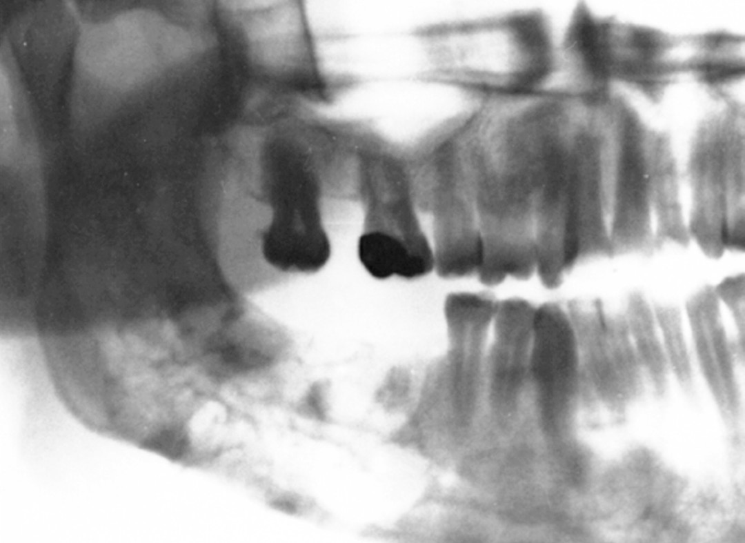 Iter diagnostico per la diagnosi delle lesioni radiotrasparenti dei mascellari incluso (in tal caso è indistinguibile da una cisti dentigera) [4,8].