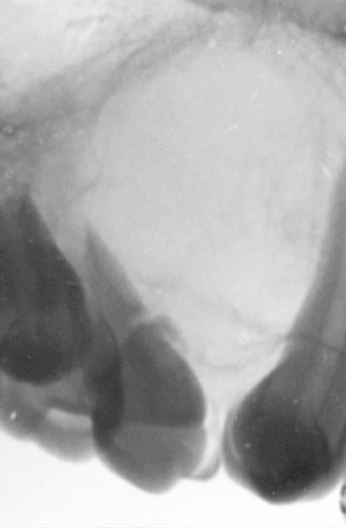 Iter diagnostico per la diagnosi delle lesioni radiotrasparenti dei mascellari Dopo l asportazione il fibroma odontogeno non tende a recidivare [12]. Mixoma.