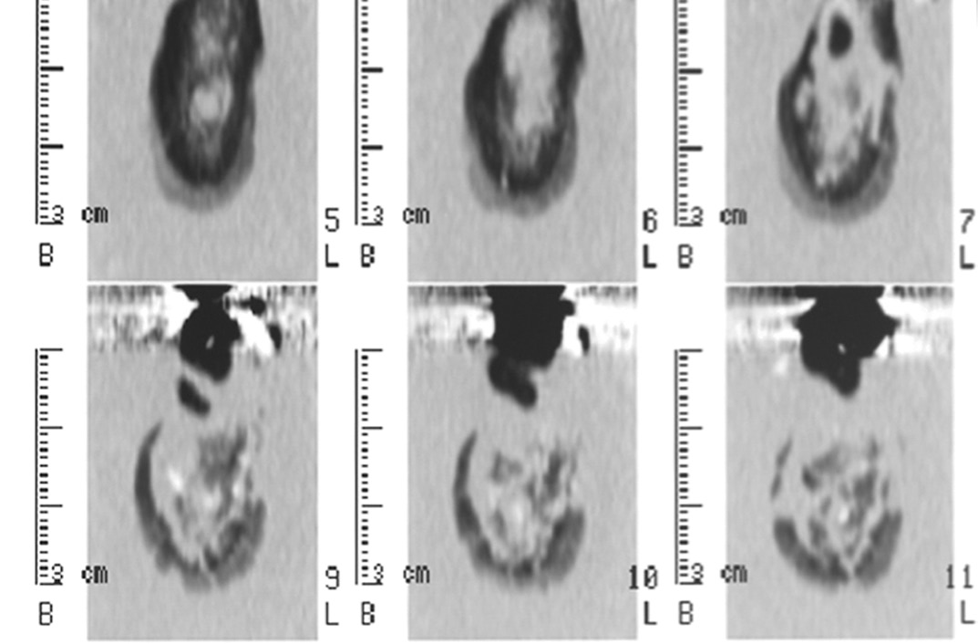 Iter diagnostico per la diagnosi delle lesioni radiotrasparenti dei mascellari complicanze gravi a livello del cavo orale (fig. 16a-d).