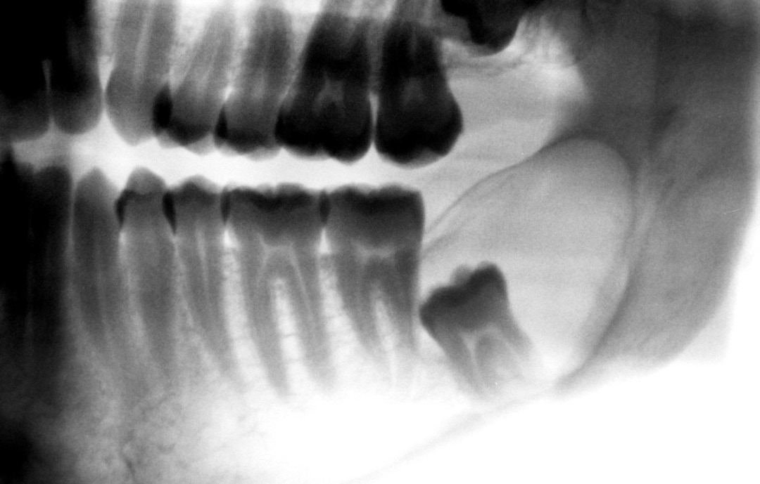 T. Anedda et al. molare superiore e secondo premolare inferiore [9]. Presenta un accumulo di fluido tra epitelio dell organo dello smalto ridotto e lo smalto del dente.