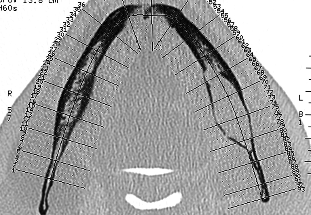 Iter diagnostico per la diagnosi delle lesioni radiotrasparenti dei mascellari Fig. 5a Fig. 5b e localizzata in un area edentula [13] (fig. 5a-e).