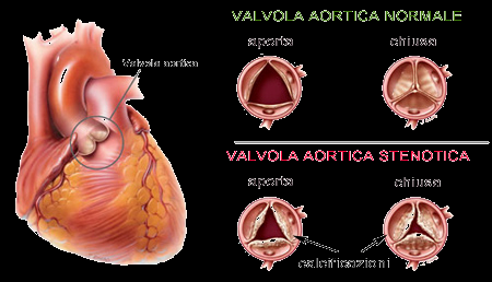 La terapia della SAO in pazienti ad elevato rischio chirurgico e stata modificata