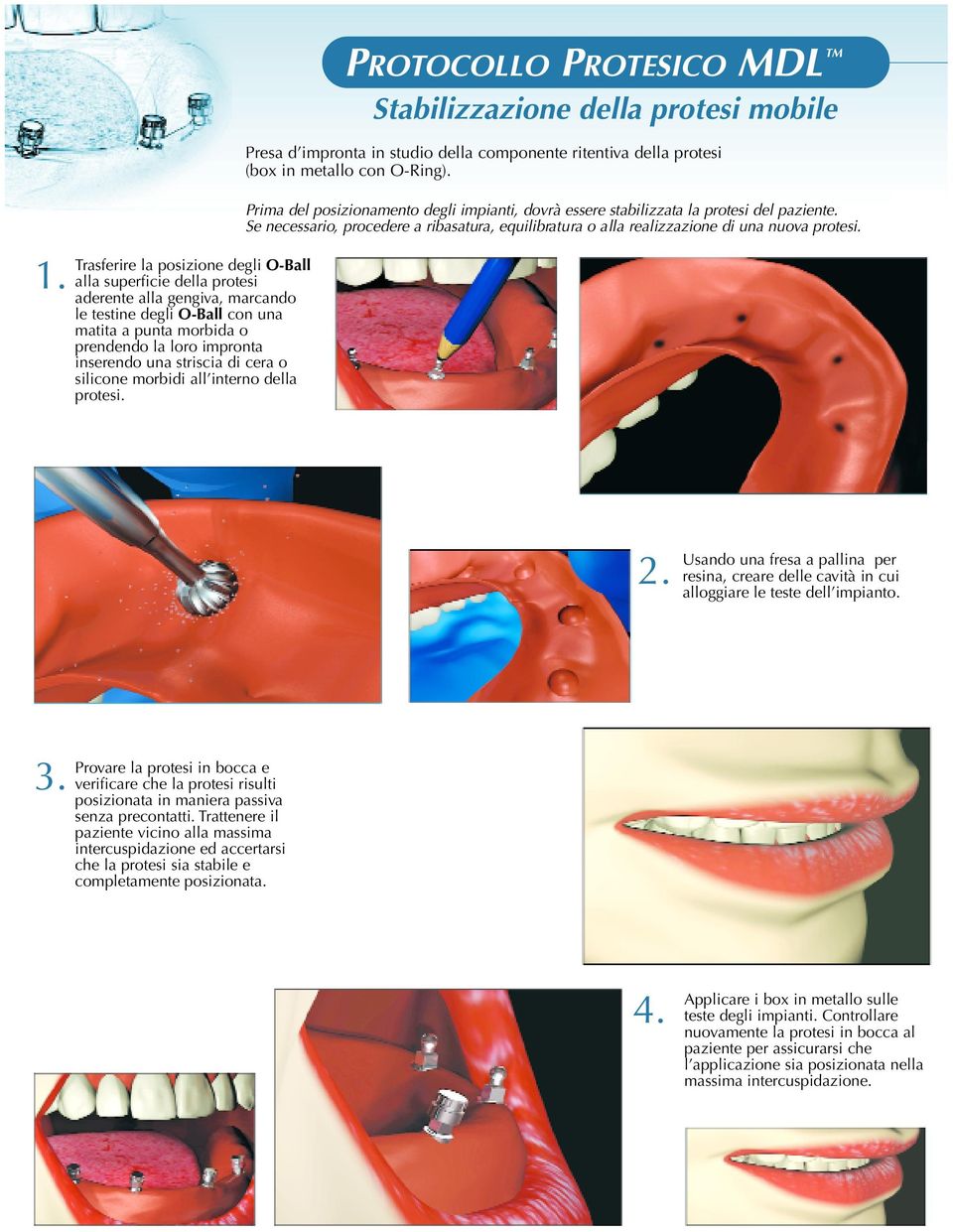 PROTOCOLLO PROTESICO MDL Stabilizzazione della protesi mobile Presa d impronta in studio della componente ritentiva della protesi (box in metallo con O-Ring).