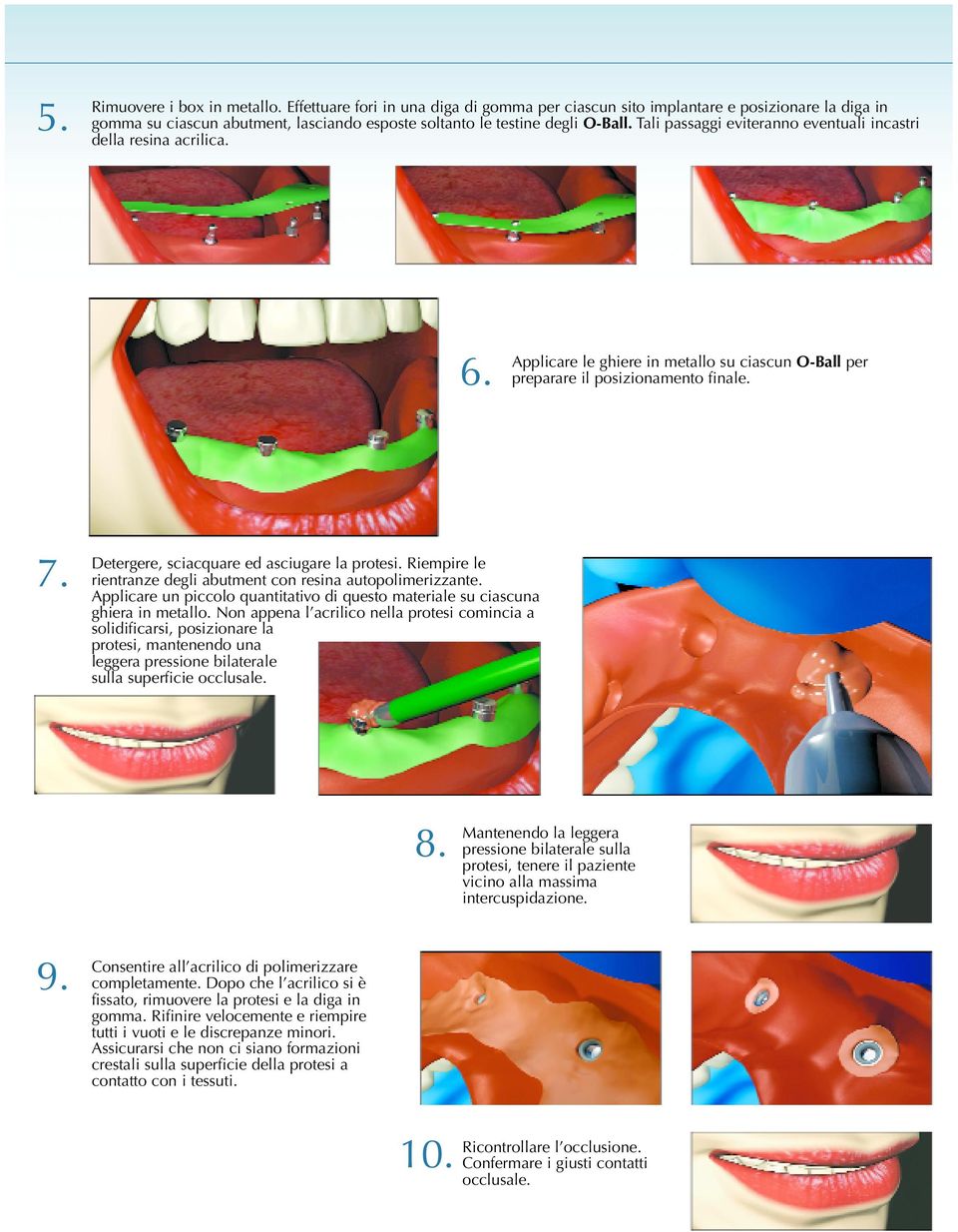 Detergere, sciacquare ed asciugare la protesi. Riempire le rientranze degli abutment con resina autopolimerizzante. Applicare un piccolo quantitativo di questo materiale su ciascuna ghiera in metallo.