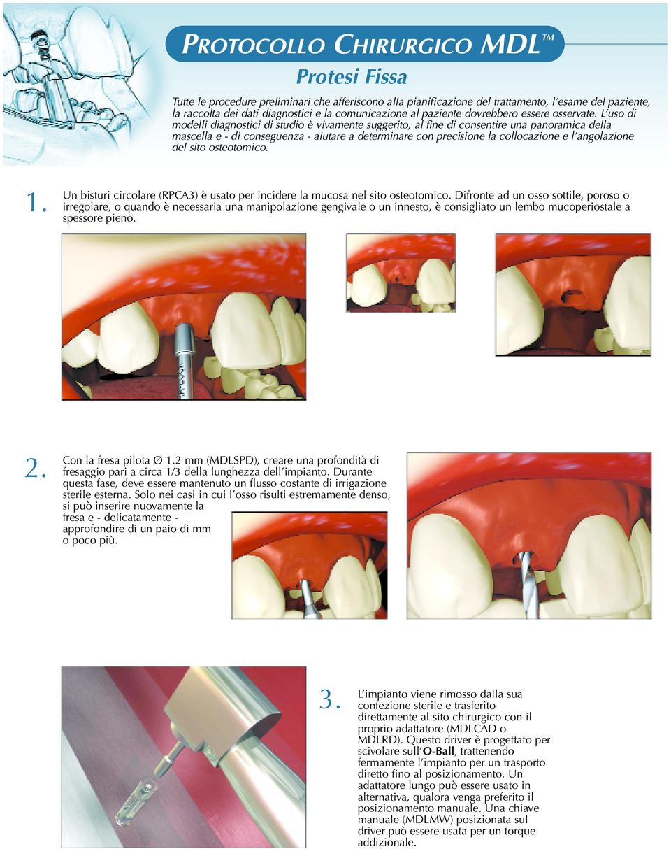 L uso di modelli diagnostici di studio è vivamente suggerito, al fine di consentire una panoramica della mascella e - di conseguenza - aiutare a determinare con precisione la collocazione e l