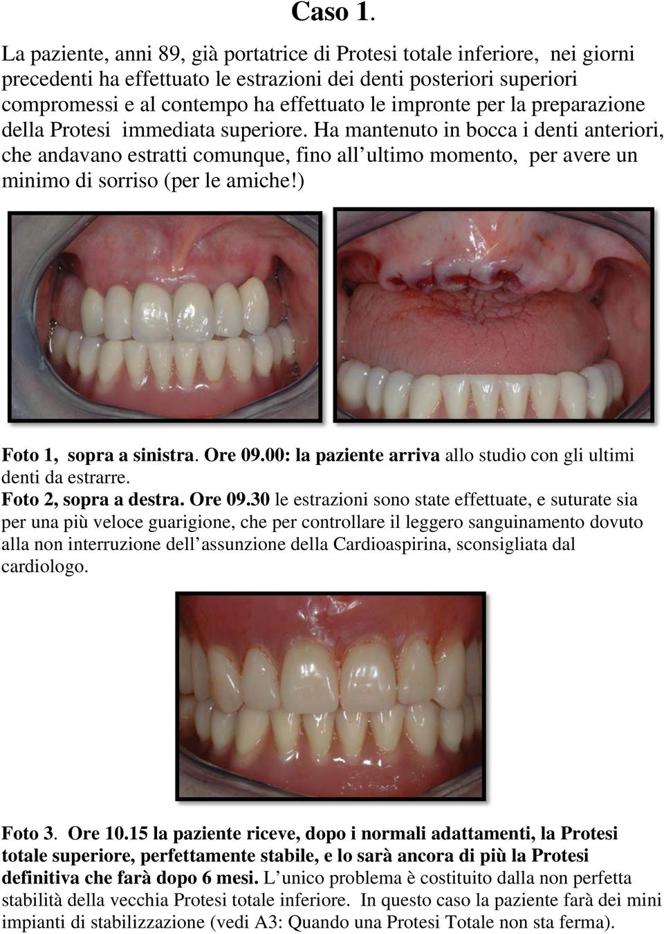 per la preparazione della Protesi immediata superiore. Ha mantenuto in bocca i denti anteriori, che andavano estratti comunque, fino all ultimo momento, per avere un minimo di sorriso (per le amiche!