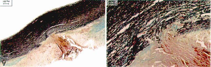 ATEROSCLEROSI AORTICA Rottura della placca aterosclerotica e