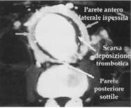 Aneurisma infiammatorio dell aorta addominale diagnosi ANGIO- TAC La TAC me3e in evidenza una cotenna