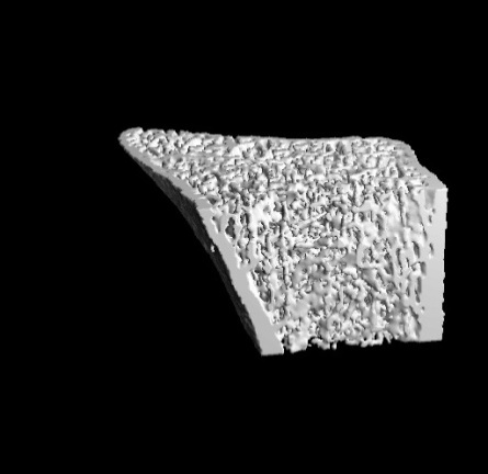 Greater increases in cortical BMD at the radius (HR-pQCT) Bone architecture pilot study Total vbmd Trabecular vbmd Cortical vbmd Percent Change at month 12 vs baseline 1,5 1 0,5 0-0,5-1 -1,5-2 * *