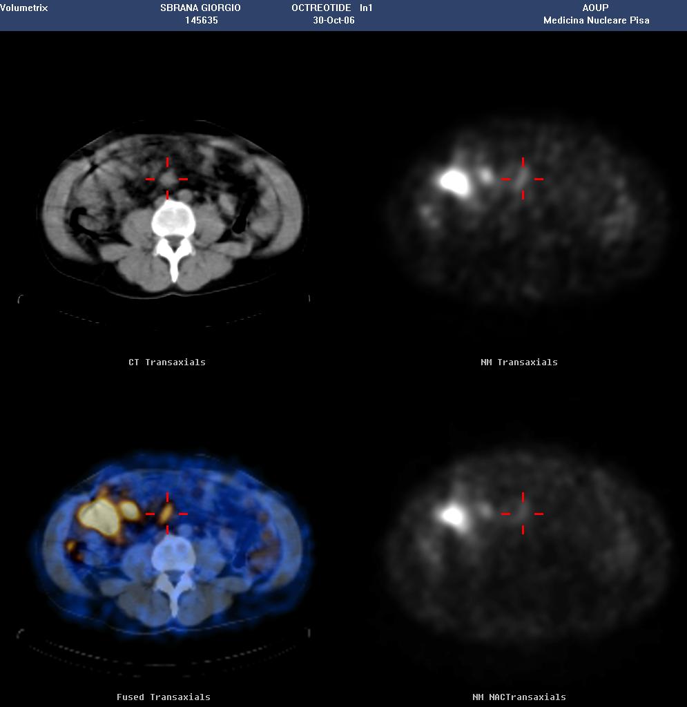 Octreoscan : SPECT/CT Carcinoide