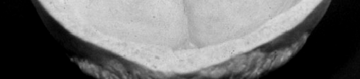 Anatomia - ipofisi Sagittale anatomica peduncolo Tubercolo sellare Coronale
