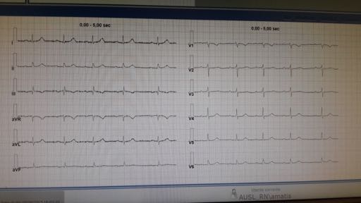 ECG