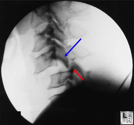 IPERFLESSIONE con ROTAZIONE una delle faccette articolari interapofisarie agisce come fulcro e la rotazione piu' flessione della colonna fanno sì che la faccetta controlaterale venga dislocata.