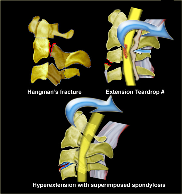 IPERESTENSIONE Iperestensione : compressione