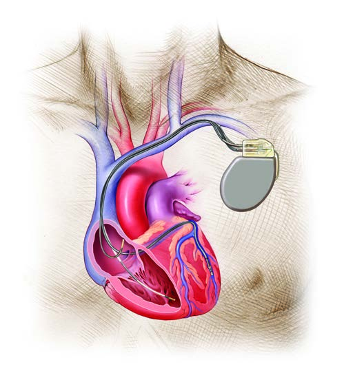 Elettrocatetere nell atrio destro CRT-D impiantato Elettrocatetere all interno della vena del seno coronarico Elettrocatetere nel ventricolo destro Figura 8. Sistema CRT-D impiantato.