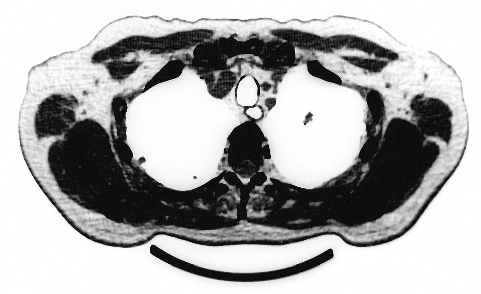 2 Recenti Progressi in Medicina, 106 (6), giugno 2015 Nel maggio 2013, il paziente veniva ricoverato per un episodio di occlusione intestinale e una sepsi generalizzata da Enterococcus faecalis.