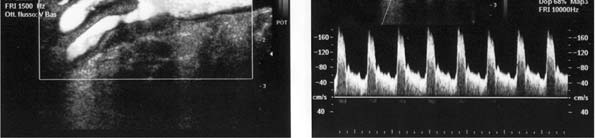 CODIFICA DEI CRITERI OPERATIVI: 1) Quantificazione emodinamica del grado di stenosi mediante il doppler pulsato con correzione dell angolo d incidenza come per numerose altre indagini strumentali