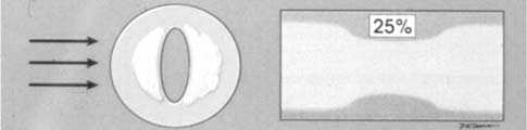 2) Quantificazione anatomica della stenosi mediante immagine con color-doppler o, meglio, con angio-color-power (CPA) e misurazione del lume residuo (Diametri o Aree) ECST (European Carotid Surgery