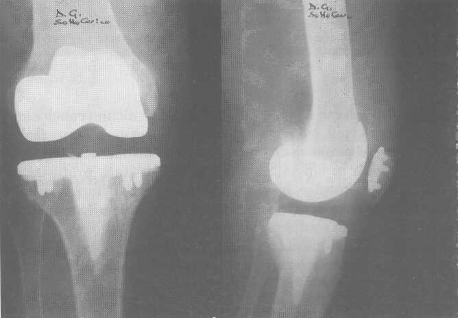 Protesi di ginocchio con o senza protesizzazione della rotula: Risultati e commenti Fig.