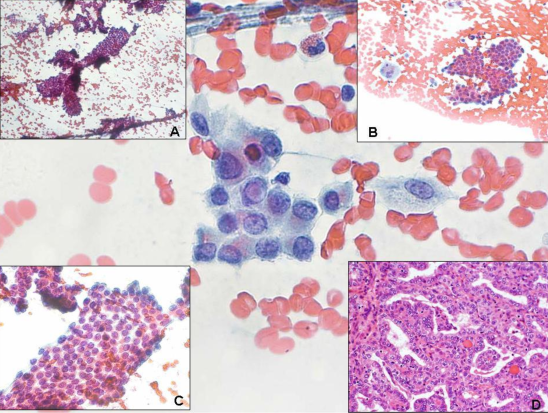 Biopsia (3) A. Archite7ura papillare (magnificazione X4). B. Macrofagi e carcinoma papillare (magnificazione X10). C.