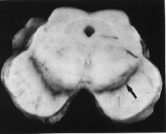 Sostanza nera del Soemmering è divisa in parte compatta (più scura) e reticolata (rossiccia, ricca di Fe) riceve AFFERENZE: fascicolo strionigro dal nucleo caudato e vie corticonigre dalla corteccia