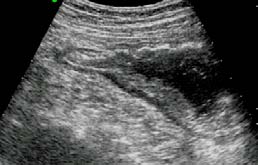 studi su CEUS e TGE (Ca Gastrico e GIST) Carcinoma Gastrico Ruolo dell US transcutanea Esame indicato in dispeptici con sintomi di allarme (linee