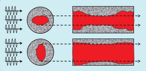 2) Quantificazione anatomica della stenosi mediante immagine con color-doppler o, meglio, con angio-color-power (CPA) e misurazione del lume residuo (Diametri o Aree) A=05 mm B=07 mm C=09 mm D=10 mm