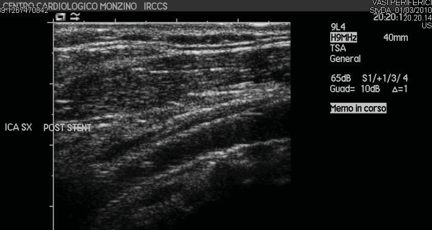 Lesioni a distanza dopo intervento di endoaterectomia (TEA) o Angioplastica Transluminare Percutanea con Stenting (PTA- Stenting).