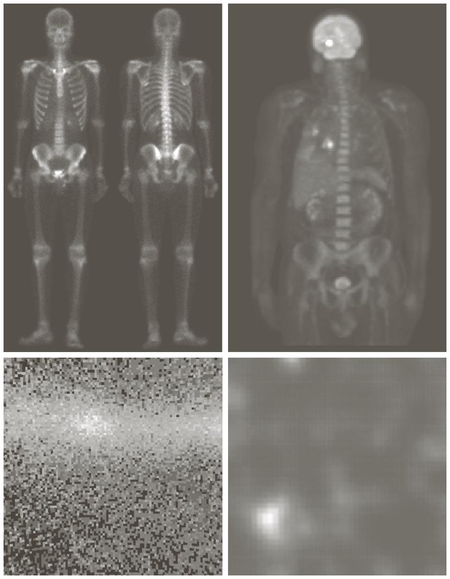 Applicazioni (2) A) B) Immagini a raggi gamma: A) Scansione delle ossa rilevando i raggi gamma emessi da isotopi radioattivi introdotti nel paziente B)