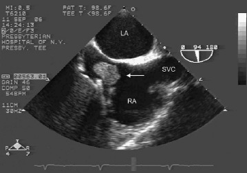 FOP, ASA e stroke possibili fattori associati 1 Sebbene gli studi prospettici sembrino non confermare l associazione messa in evidenza dagli studi caso-controllo, possono essere tratte alcune