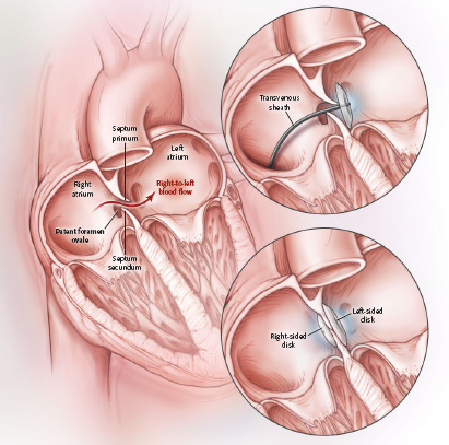 FOP, ASA e stroke chiusura percutanea transcatetere Mediante accesso venoso femorale si introduce una guida dotata di disco ripiegato attraverso il FOP, e viene quindi rilasciato e tirato indietro