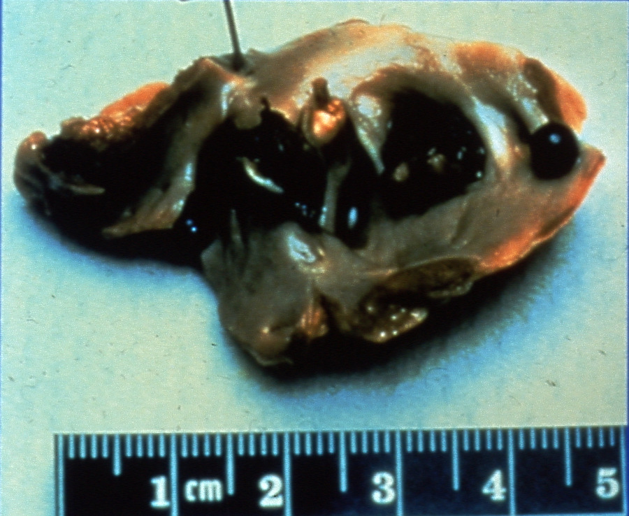 di circa il 20-25% di tutti gli ictus cerebri Di questi,la metà è causata da trombosi