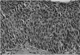 Cervicocarcinoma: forma preinvasiva CIN: cervical intraepithelial neoplasia CIN1 Displasia lieve CIN2 Displasia moderata CIN3 Displasia grave Cervicocarcinoma Forma