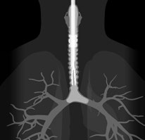 RÜSCH EZ-BLOCKER BLOCCATORE ENDOBRONCHIALE GUIDA ALL USO DEL PRODOTTO 1 2 3 FIGURA 1: VENTILAZIONE Dopo l intubazione del paziente con un tubo endotracheale di misura corretta, si deve connettere l