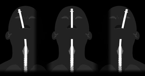 SUGGERIMENTI PER L INSERIMENTO Le estremità distali dell EZ-Blocker sono lunghe circa 4 cm, quindi per consentire il corretto posizionamento delle estremità distali a forma di Y, l intubazione deve