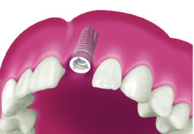 Situazione a seguito di perdita di un dente Fase di guarigione terminata Impianto protesizzato con corona 11 Perdita di un dente singolo.