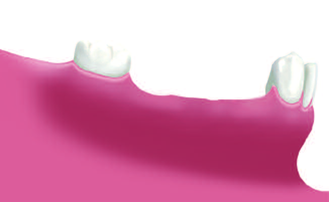 Situazione dopo la perdita di più denti (selle edentule) Due impianti con fase di guarigione terminata Ponte a tre elementi su due impianti 13 Perdita di più denti.
