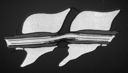 Spondilomielopatia cervicale (sindrome di Wobbler) Elementi che concorrono alla compressione statica Stenosi del canale vertebrale (di solito associata ad instabilità) Malformazione di processi