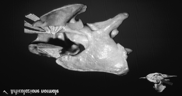 Instabilità atlanto-assiale (atlanto-epistrofea) Lesione con componenti genetiche che colpisce giovani cani di piccola taglia Caratterizzata da