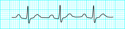 ECG COSA SAPERE PER NON FARSI PRENDERE DAL PANICO