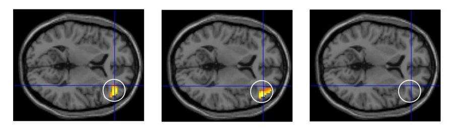 Reward Probabilistic Reversal Learning Task Less activation Ventro lateral prefrontal cortex Controls Smokers Problem Gamblers Reward associated with activation Right VLPFC, Right Occipital/Parietal