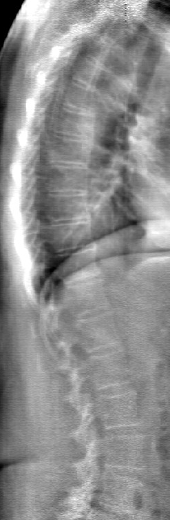 DEXA Il funzionamento della DEXA è basato sull "attenuazione": un fascio di raggi X attraversando un materiale riduce la propria intensità e perciò avrà un valore in uscita dal materiale stesso,