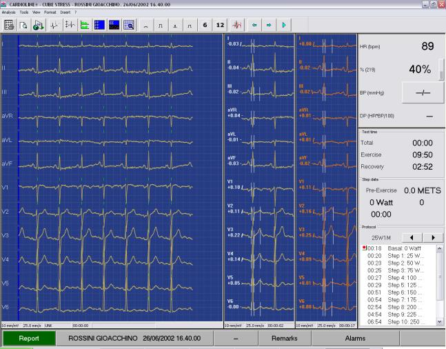 sempre presente per garantire un sicuro monitoraggio del paziente; - la finestra ST - QT realtime focalizza l attenzione dell operatore sull analisi del tratto ST e QT e consente di fare misure