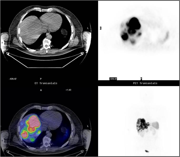 68 Ga-DOTATOC PET/CT Pre-terapia Post-terapia R.A., M, 59aa: metastasi epatiche da ca neuroendocrino da primitivo a sede ignota.